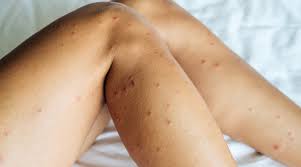 Red spider mite bites on humans. Dust Mite Bites Or Bed Bugs See This Infographic To Find Out