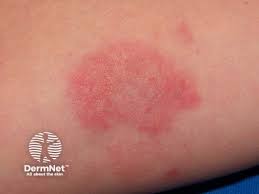 Image result for Vasculitis