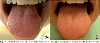Jul 30, 2020 · transient lingual papillitis can present with mild tenderness to severe pain. Pdf Transient Lingual Papillitis A Retrospective Study Of 11 Cases And Review Of The Literature Semantic Scholar