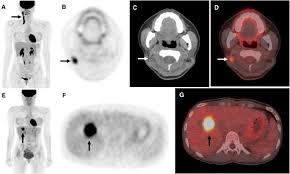 Positron emission tomography (pet) imaging or pet scan is a nuclear medicine imaging. 18 F Fdg Pet Ct Surveillance At 3 6 And 12 Months For Detection Of Recurrence And Second Primary Cancer In Patients With Head And Neck Squamous Cell Carcinoma British Journal Of Cancer