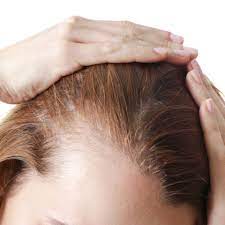It is called androgenetic alopecia 2 and is common in men. Causes Of Hair Loss In Women Moore Unique Skin Care