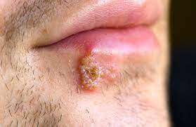I also thinks it's awesome that you have built up a nice little nest egg for yourself. Herpes Aidsmap