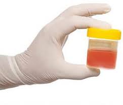 Image result for hematuria