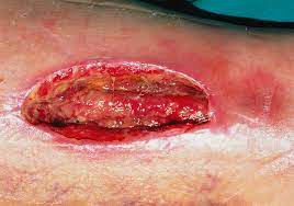 Close Up Of An Open And Infected Leg Wound Photograph by Garry Watson/science Photo Library