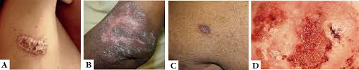 Tuberculosis verrucosa cutis (prosector's wart) occurs after exogenous direct inoculation of the mycobacteria into the skin of a previously sensitized patient who has moderate to high immunity against the bacilli. Scielo Brasil Update On Cutaneous Tuberculosis Update On Cutaneous Tuberculosis