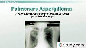 Treatment also depends upon the type of disease and its. What Is Aspergillosis Fungal Infections Symptoms Video Lesson Transcript Study Com