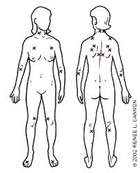 Trigger Points Diagnosis And Management American Family