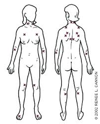 trigger points diagnosis and management american family