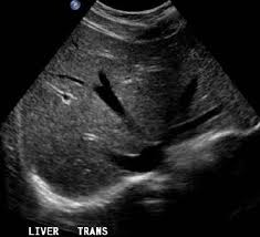 Simply moving a sound wave generator—called a transducer—over your your doctor may order this type of ultrasound to look for a blood clot or a blockage in your circulatory system. Normal Liver Ultrasound How To Ultrasound Sonography Ultrasound School