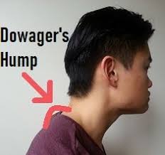 Dowager's hump is an outward curvature of the thoracic vertebrae of the upper back. How To Get Rid Of A Dowager S Hump Posture Direct