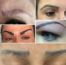 Particularly eyebrow tattoos and lip applications. Microblading Eyebrow Tattoo Removal Clean Slate Laser Tattoo Removal