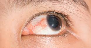 Image result for Scleritis