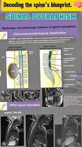Image result for Spinal Dysraphism