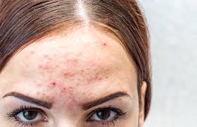 As well as treating acne externally, lifestyle factors such as diet and sleep can be major players in balancing hormones and alleviating consequent symptoms. Hormonal Acne How To Treat It Effectively