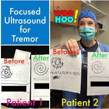 Image result for Essential Tremor