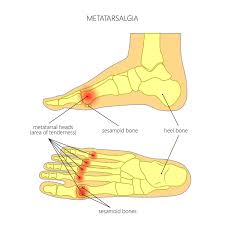 Image result for Metatarsalgia