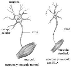 Es una enfermedad neuromuscular rápidamente progresiva que afecta a las células nerviosas del cerebro y de la médula espinal. Dolor Y Ela Cuando Solo Podemos Cuidar Blogs Quironsalud