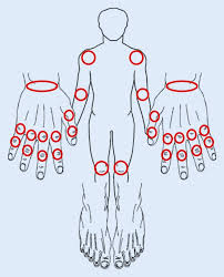 In a randomized clinical trial, injection site reactions were reported in 25% of patients given placebo and in 50%, 73%, and 81% of patients given anakinra in doses of 30, 75, and 150 mg/day. Management Der Fruhen Rheumatoiden Arthritis Springerlink