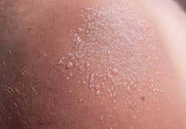 Image result for Sunburn