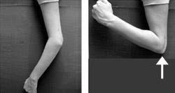 Olekranon Dirsek Kiriklari