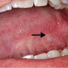 One of the first signs of tongue cancer is a lump or sore on the side of your tongue that doesn't go away. Known Cancer Patient Presenting With A Small Erosive Lesion On The Left Download Scientific Diagram