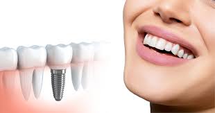 Clearchoice dental implant centers are locally owned and operated by licensed dentists, and are part of a professional affiliation of implant practices operated by oral surgeons, prosthodontists, and restorative dentists across the u.s. Why Are Dental Implants Necessary
