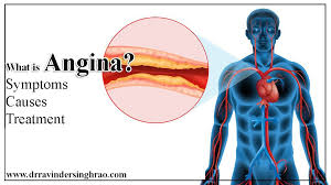 Image result for Angina Pectoris