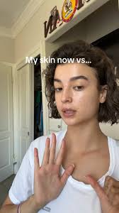 Grateful is an UNDERSTATEMENT! 😭 #acnejourney #iykyk #onthisday