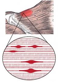 trigger points physiopedia