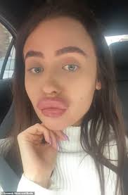 Noticing swollen ankles after a flight is not uncommon for airline passengers, but that doesn't mean it's not a cause for concern. Flight Attendant 21 Claims That A 100 Filler Treatment Left Her Lips So Swollen Readsector