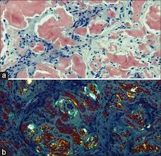 Common diseases for congo red stain include primary amyloidosis, al amyloid seen in plasma cell dyscrasias, aa amyloid. View Image