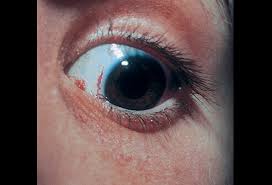 Learn about telangiectasia or find a doctor at mount sinai health system. Ataxia Telangiectasia Picture Image On Medicinenet Com