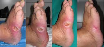Image result for diabetic toes