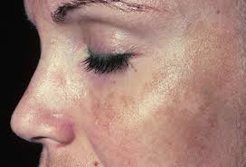 Image result for Melasma
