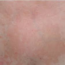Also called pityriasis versicolor we all have yeast living on our skin. Pityriasis Versicolor In A 42 Year Old Female Patient The Patient Had Download Scientific Diagram