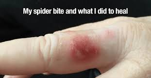 Image result for Spider Bite