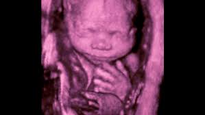 The cd will have all of your 3d still images taken during your ultrasound. 3d Or 4d Ultrasound Vs 2d Ultrasound