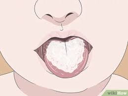So erkennen sie die krankheit frühstmöglich. Mundsoor Erkennen Wikihow