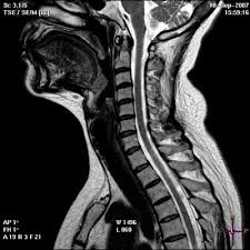 A esclerose múltipla (em) é uma doença autoimune que afeta o cérebro e a medula espinhal. Ressonancia Magnetica Coluna Radiologia De Albufeira