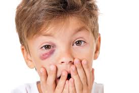 Eye emergencies can be alarming. Emergency Eye Care Munster In Urgent Eye Care Gailmard Eye Center