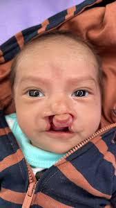 In the past four days, we traveled across three different states in  Guatemala to visit and evaluate our patients — something we’ve proudly done  for over 15 years!, During this trip, we saw over 380 ...