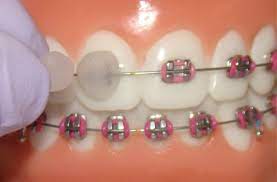 Next, brush your teeth thoroughly but gently to ensure that your braces are adequately clean. Orthodontic Wax Can Be The Answer To Discomfort And Irritation Texas Orthodontic Specialists
