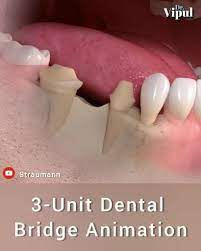3 Unit Dental Bridge Video En 2021 Odontologia Protesis Dental Fija Implantes Dentales