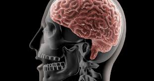 Poches de sang dans le cerveau une blessure à la tête peut causer un saignement dans le cerveau. Accident Vasculaire Cerebral Avc Personnes A Risque