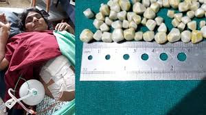 Pada tahap awal pemeriksaan, dokter akan menanyakan gejala yang muncul dan melakukan pemeriksaan fisik terhadap pasien. 1 Tahun Lebih Alami Sakit Perut Parah 148 Batu Empedu Dikeluarkan Dari Tubuh Wanita Ini Halaman All Tribun Pekanbaru