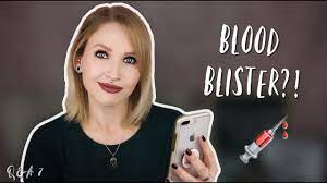 Blood Blisters On Piercings Body Mods Q A 7 Youtube