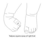 Image result for icd 10 code for congenital talipes equinovarus