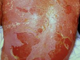 A review of adverse cutaneous events reported in sweden as associated with this drug. Stevens Johnson Syndrome Toxic Epidermal Necrolysis Dermnet Nz