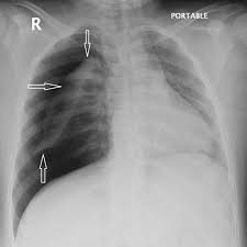 Image result for Pneumothorax