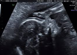 Was passiert bei der feindiagnostik? Feindiagnostik 21 0 Und Plotzlich 23 Ssw Geburtstermin September Oktober 2020 9monate De